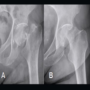 cadera radiografía